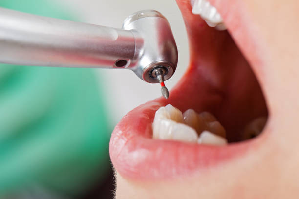 Best Emergency Root Canal Treatment in Applewood, CO